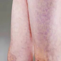 大腿有紫色瘀痕图片