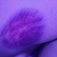 大腿有紫色瘀痕图片