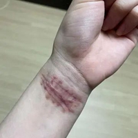 手腕割伤疤痕真实图片