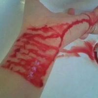 手腕割伤疤痕真实图片